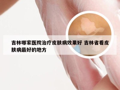 吉林哪家医院治疗皮肤病效果好 吉林省看皮肤病最好的地方