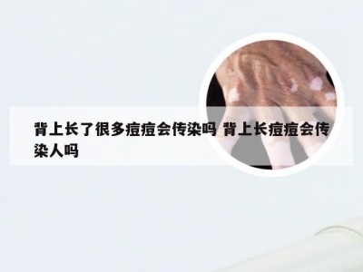 背上长了很多痘痘会传染吗 背上长痘痘会传染人吗