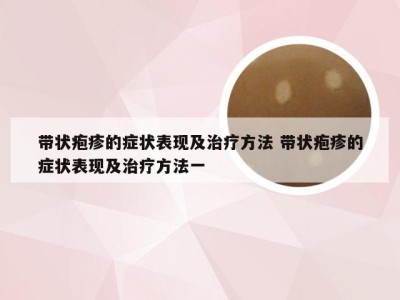 带状疱疹的症状表现及治疗方法 带状疱疹的症状表现及治疗方法一