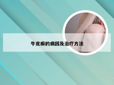 牛皮癣的病因及治疗方法