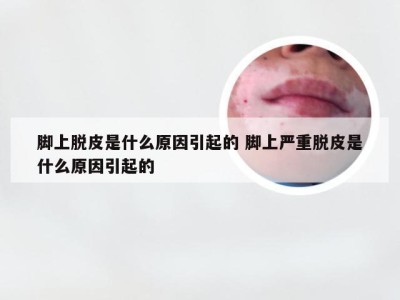 脚上脱皮是什么原因引起的 脚上严重脱皮是什么原因引起的