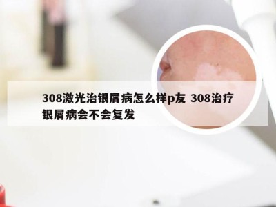 308激光治银屑病怎么样p友 308治疗银屑病会不会复发