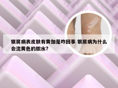 银屑病表皮肤有黄伽是咋回事 银屑病为什么会流黄色的脓水?