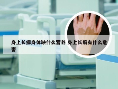 身上长癣身体缺什么营养 身上长癣有什么危害