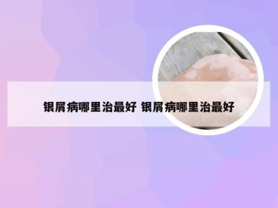 银屑病哪里治最好 银屑病哪里治最好