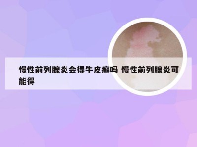 慢性前列腺炎会得牛皮癣吗 慢性前列腺炎可能得