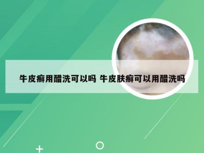 牛皮癣用醋洗可以吗 牛皮肤癣可以用醋洗吗