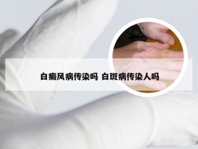 白癜风病传染吗 白斑病传染人吗