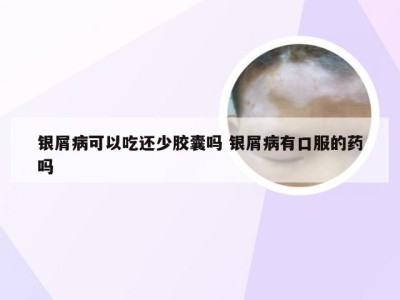 银屑病可以吃还少胶囊吗 银屑病有口服的药吗