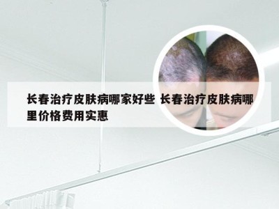 长春治疗皮肤病哪家好些 长春治疗皮肤病哪里价格费用实惠