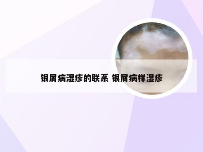 银屑病湿疹的联系 银屑病样湿疹