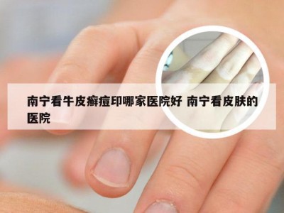 南宁看牛皮癣痘印哪家医院好 南宁看皮肤的医院