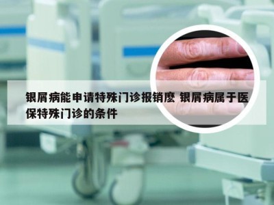 银屑病能申请特殊门诊报销麽 银屑病属于医保特殊门诊的条件