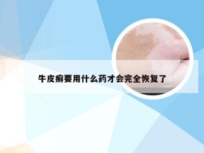 牛皮癣要用什么药才会完全恢复了