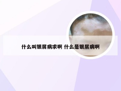 什么叫银屑病求啊 什么是银屑病啊