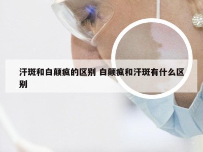 汗斑和白颠疯的区别 白颠疯和汗斑有什么区别