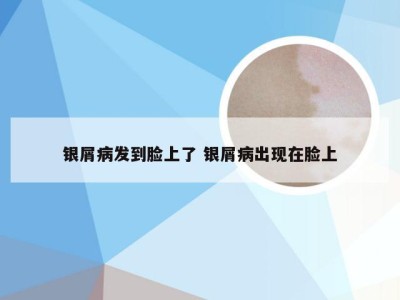 银屑病发到脸上了 银屑病出现在脸上