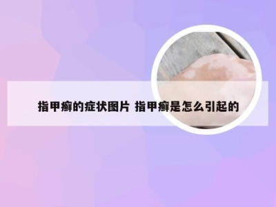 指甲癣的症状图片 指甲癣是怎么引起的