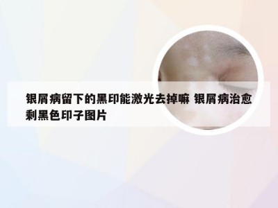 银屑病留下的黑印能激光去掉嘛 银屑病治愈剩黑色印子图片