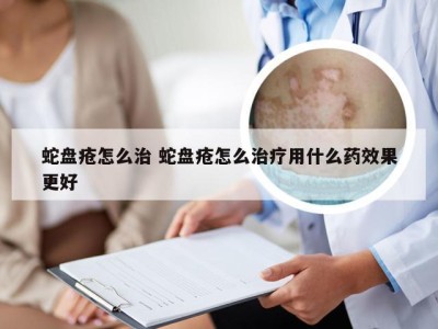 蛇盘疮怎么治 蛇盘疮怎么治疗用什么药效果更好