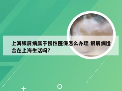 上海银屑病属于慢性医保怎么办理 银屑病适合在上海生活吗?