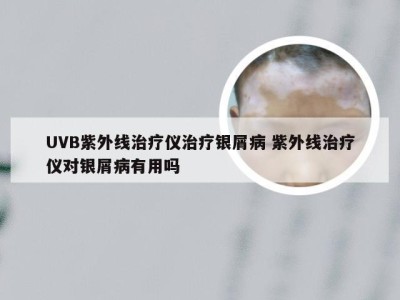 UVB紫外线治疗仪治疗银屑病 紫外线治疗仪对银屑病有用吗