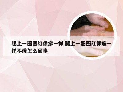 腿上一圈圈红像癣一样 腿上一圈圈红像癣一样不痒怎么回事