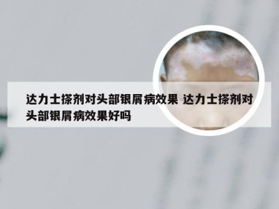 达力士搽剂对头部银屑病效果 达力士搽剂对头部银屑病效果好吗