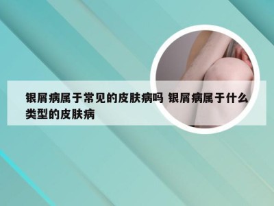 银屑病属于常见的皮肤病吗 银屑病属于什么类型的皮肤病