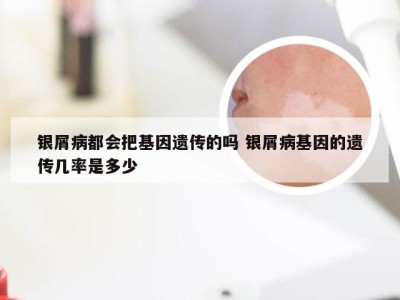 银屑病都会把基因遗传的吗 银屑病基因的遗传几率是多少