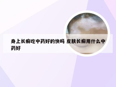 身上长癣吃中药好的快吗 皮肤长癣用什么中药好