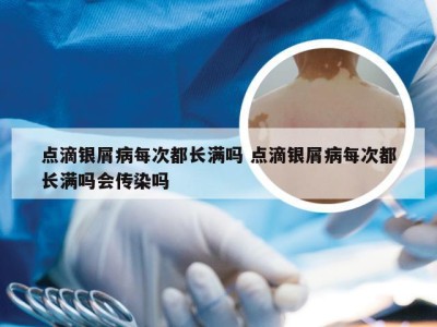 点滴银屑病每次都长满吗 点滴银屑病每次都长满吗会传染吗