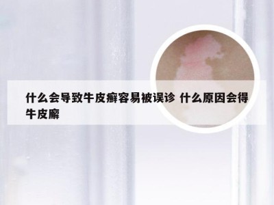 什么会导致牛皮癣容易被误诊 什么原因会得牛皮廨