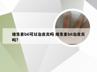 维生素b6可以治皮炎吗 维生素b6治皮炎吗?