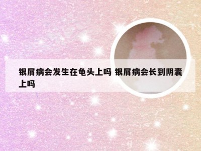 银屑病会发生在龟头上吗 银屑病会长到阴囊上吗