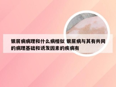 银屑病病理和什么病相似 银屑病与其有共同的病理基础和诱发因素的疾病有