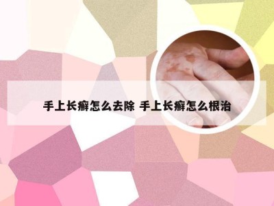 手上长癣怎么去除 手上长癣怎么根治