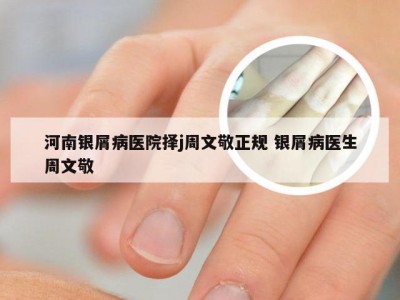 河南银屑病医院择j周文敬正规 银屑病医生周文敬