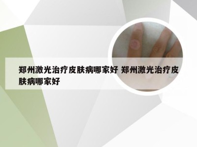 郑州激光治疗皮肤病哪家好 郑州激光治疗皮肤病哪家好