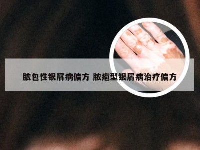 脓包性银屑病偏方 脓疱型银屑病治疗偏方