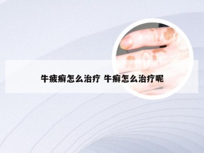 牛疲癣怎么治疗 牛癣怎么治疗呢