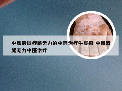 中风后遗症腿无力的中药治疗牛皮癣 中风双腿无力中医治疗