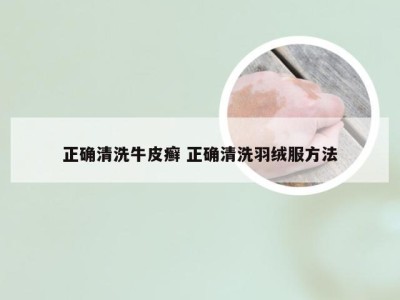 正确清洗牛皮癣 正确清洗羽绒服方法