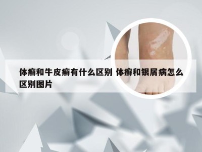 体癣和牛皮癣有什么区别 体癣和银屑病怎么区别图片