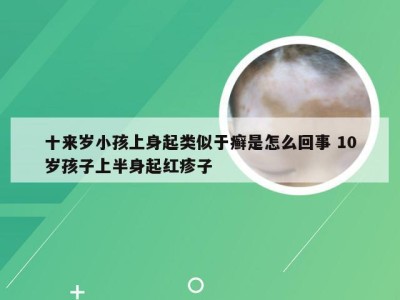 十来岁小孩上身起类似于癣是怎么回事 10岁孩子上半身起红疹子