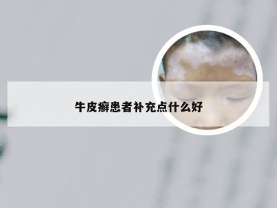 牛皮癣患者补充点什么好