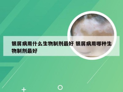 银屑病用什么生物制剂最好 银屑病用哪种生物制剂最好