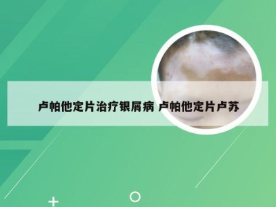 卢帕他定片治疗银屑病 卢帕他定片卢苏