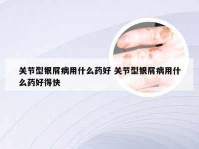 关节型银屑病用什么药好 关节型银屑病用什么药好得快