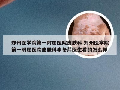 郑州医学院第一附属医院皮肤科 郑州医学院第一附属医院皮肤科李冬芹医生看的怎么样